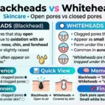 difference between blackheads and whiteheads